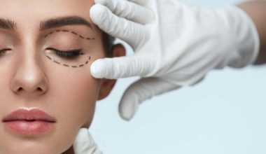Blepharoplasty before and after