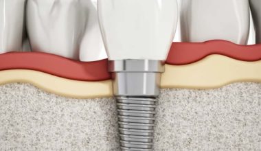 Benefits of dental implants