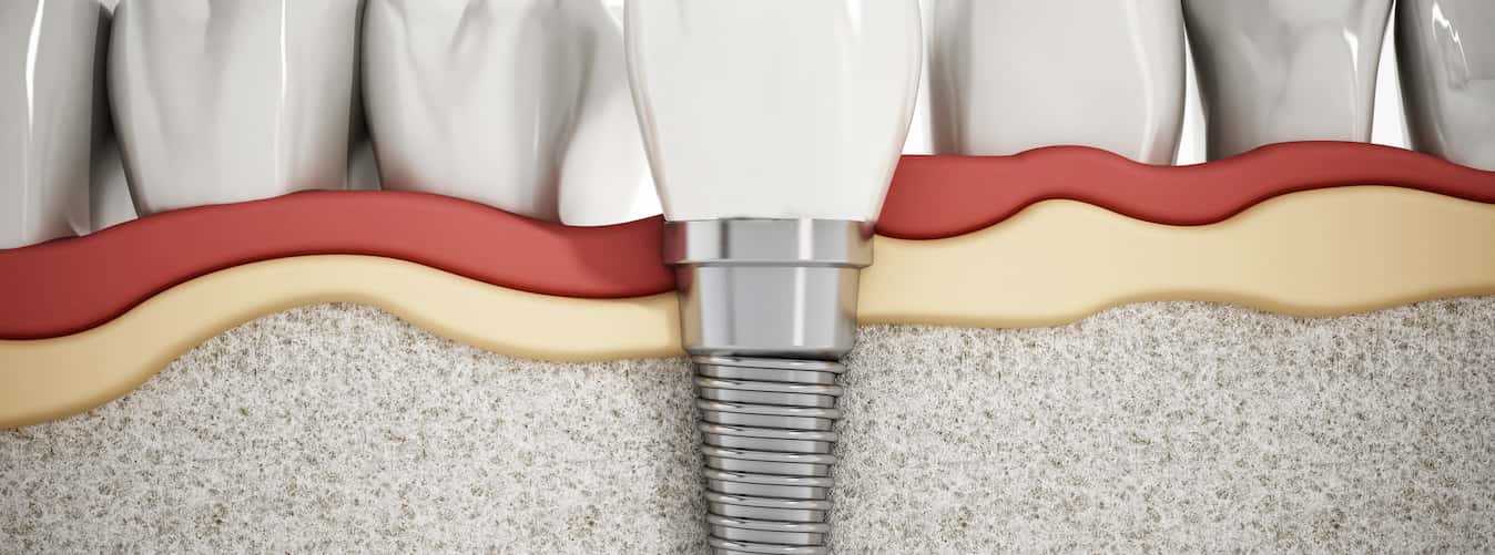 Benefits of dental implants