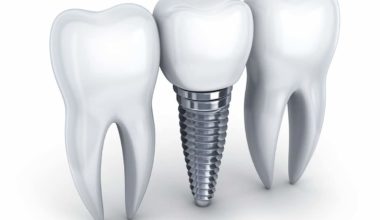 Questions about dental implants