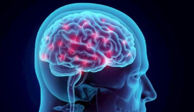 Post-Concussion Syndrome