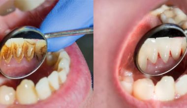 Common dental problems