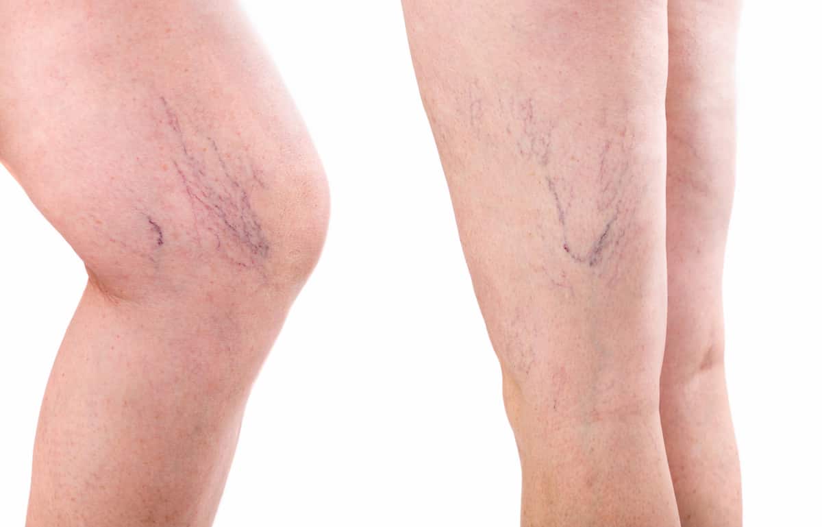 Varicose veins
