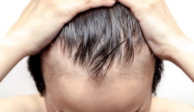 Hair transplant procedures