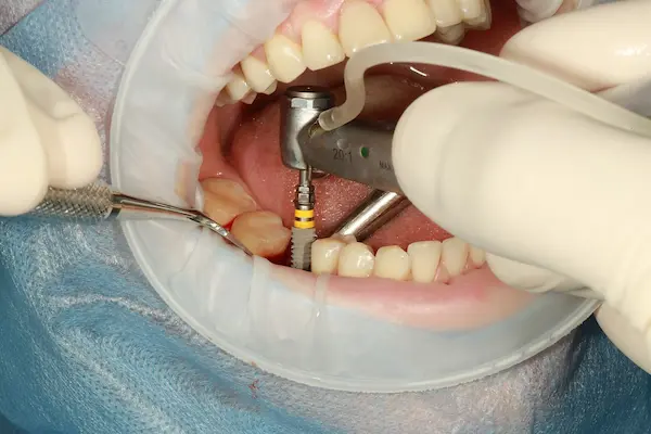 Implant Procedure